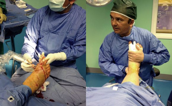 Un caso molto difficile di chirurgia del piede