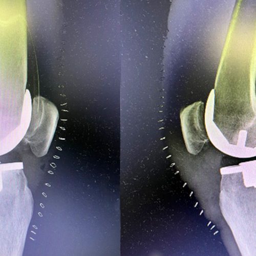 Sistema ROSA Knee