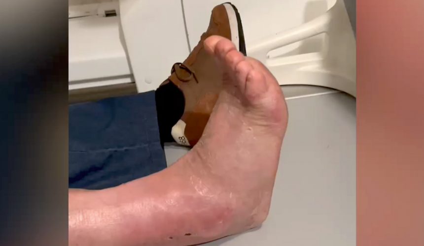 Protesi di caviglia, a soli trenta giorni dall’intervento